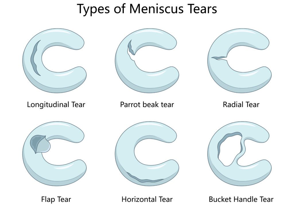 Meniscus Tear Types diagram medical science