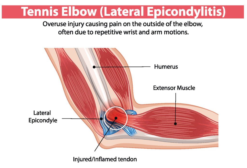 Illustration of tennis elbow injury and affected areas